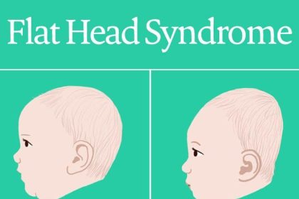 Is Flat Head Syndrome a Sign of Neglect? Debunking Myths