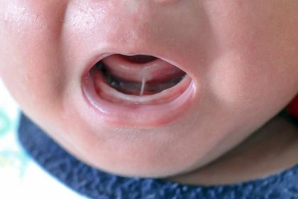 Home Remedies to Clean Baby Tongue: Gentle and Effective Methods