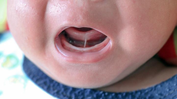 Home Remedies to Clean Baby Tongue: Gentle and Effective Methods