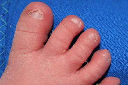 Baby Toenail Problems: Causes and Solutions