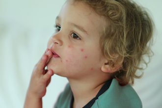 Bed Bug Bites on Babies