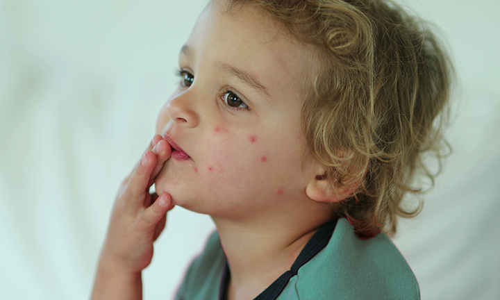 Bed Bug Bites on Babies