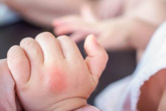 Bug Bite Cream for Babies