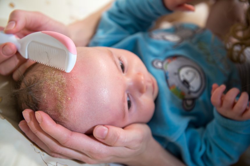 Cradle Cap Shampoo for Babies