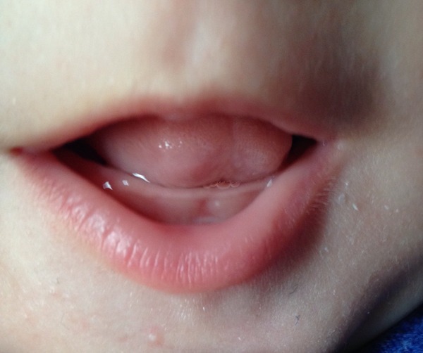 White Spot on Baby Gums at 8 Months