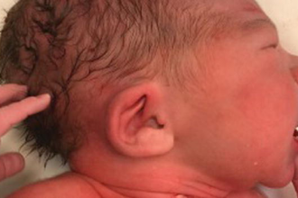 Down Syndrome Newborn Baby Ears Folded