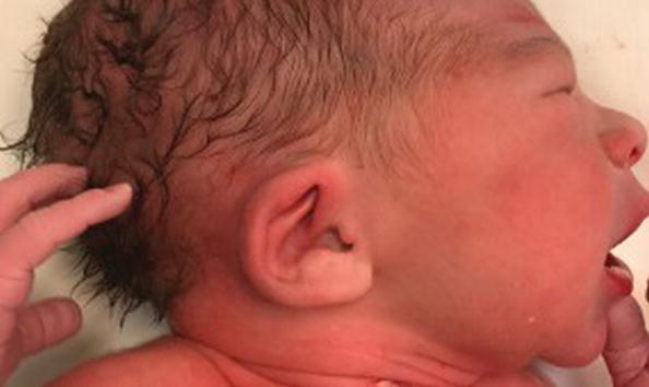 Down Syndrome Newborn Baby Ears Folded